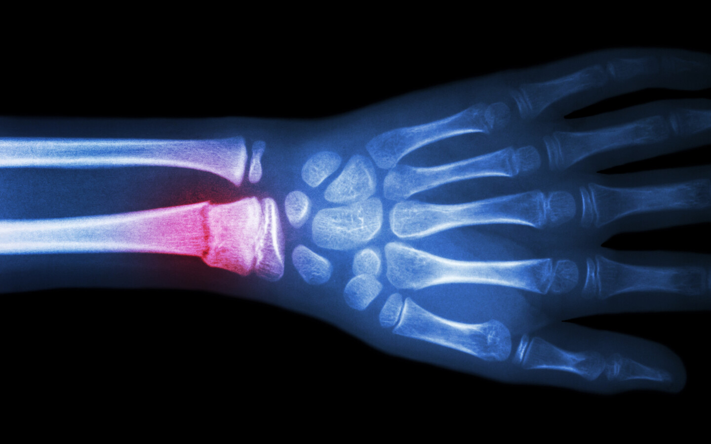 X-ray of wrist with broken bone