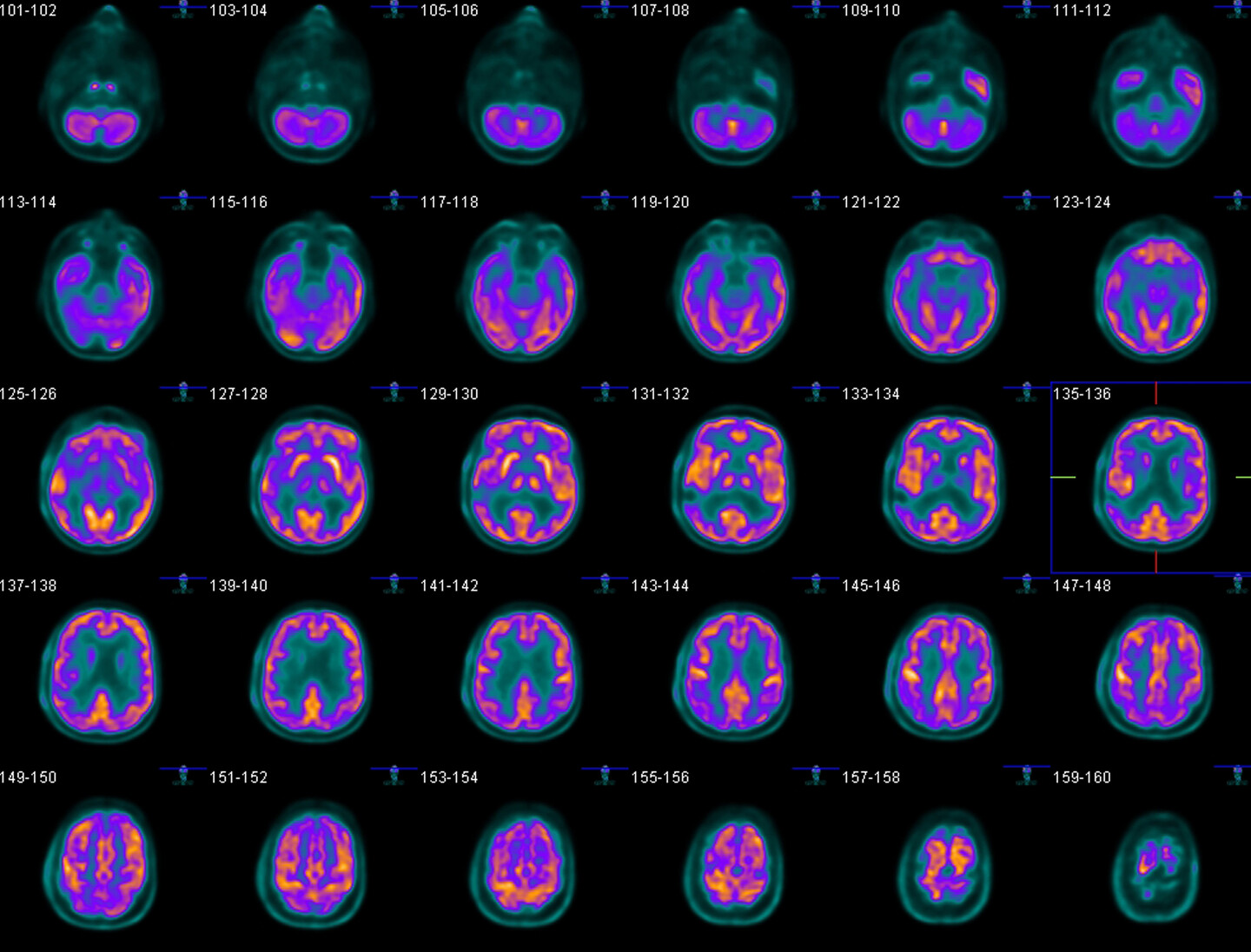 A digital visualization of a PET scan