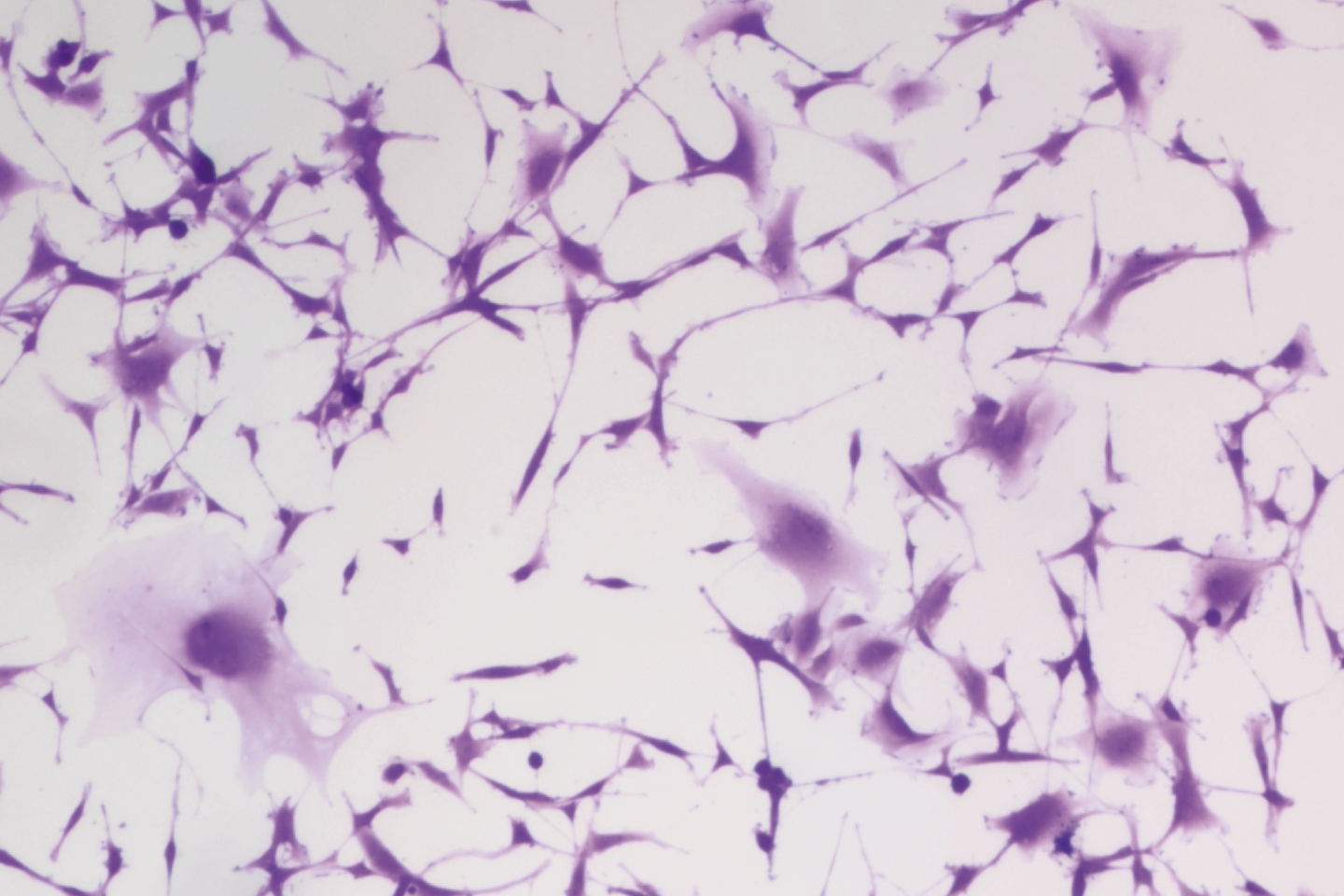 Fluorescenct imaging showing glioblastoma under a microscope.