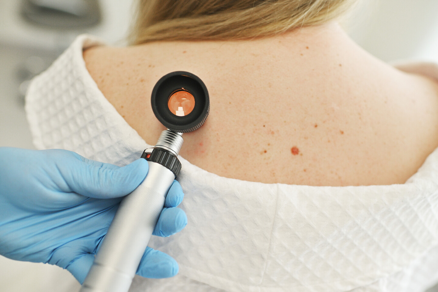 A person having a mole checked by a doctor.