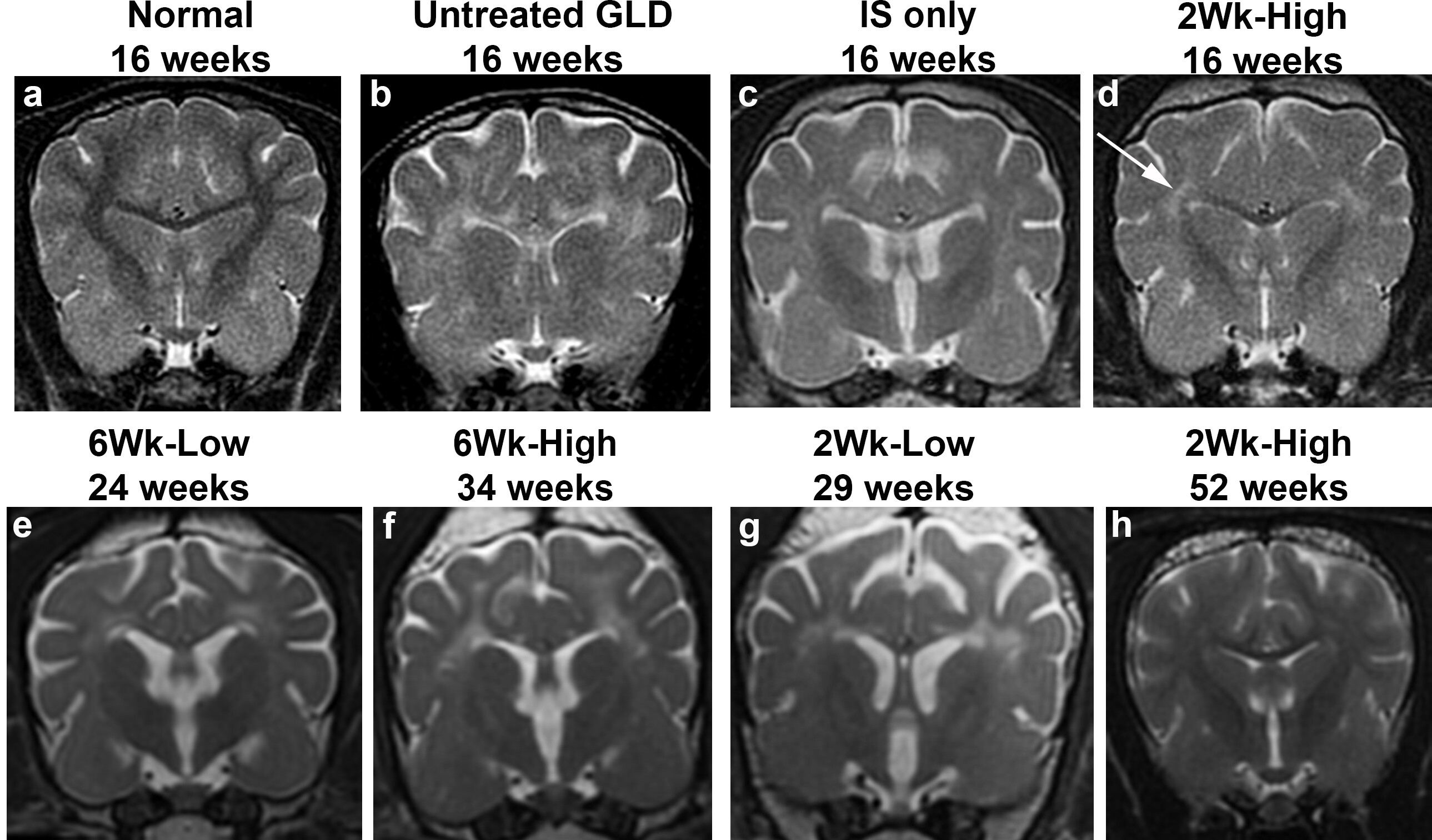 Sequence of 8 MRI images showing treated versus untreated brains from 16 to 52 weeks