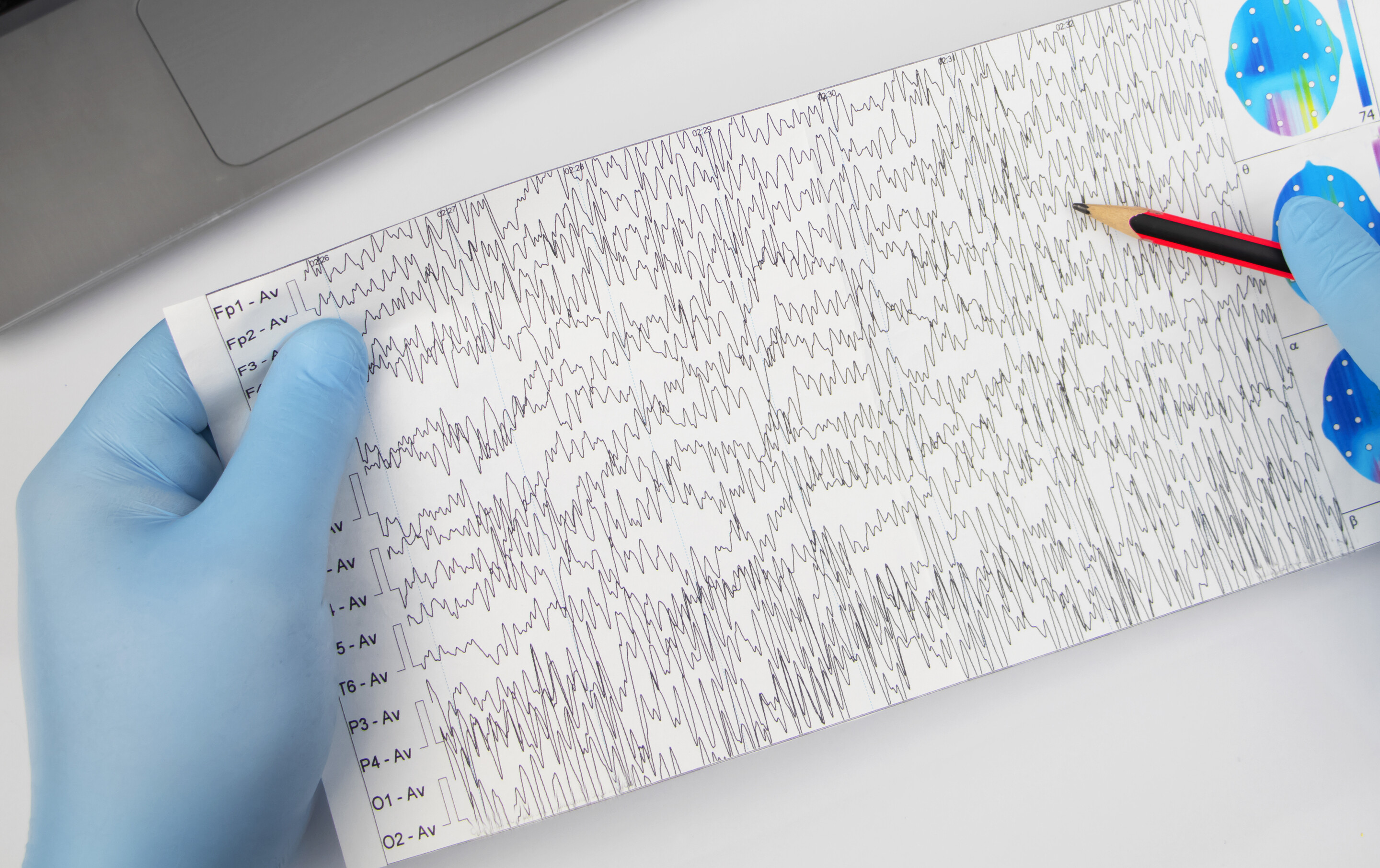 Schedule of electroencephalograms - study of brain currents for signs of epilepsy and pathologies of the nervous system. A neurologist examines an encephalogram of a patient’s brain.