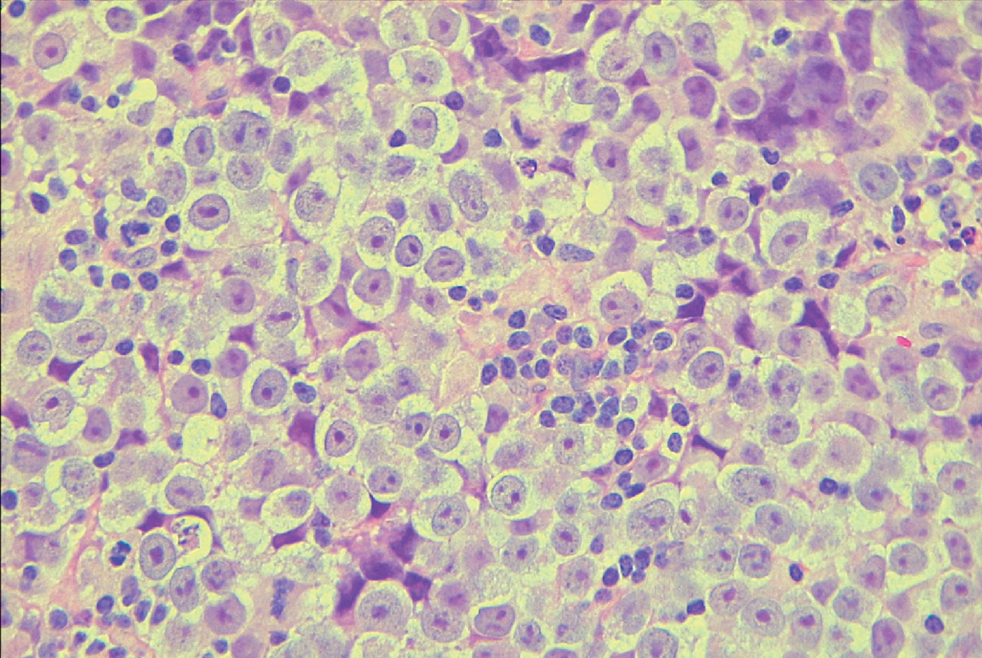 The microscopy image shows seminoma tissue in patient’s testis showing large, round cells with clear cytoplasm. The tumor tissue is heavily infiltrated by lymphocytes (small cells with dark/blue nuclei).
