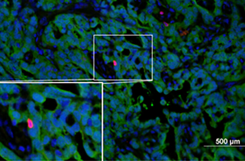 t_cell_low_tumor