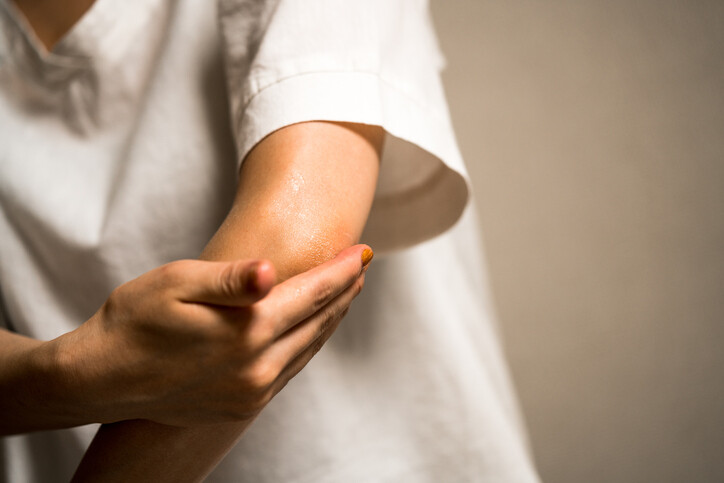 psoriasis