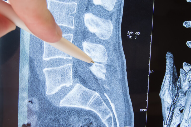 spinal x-ray