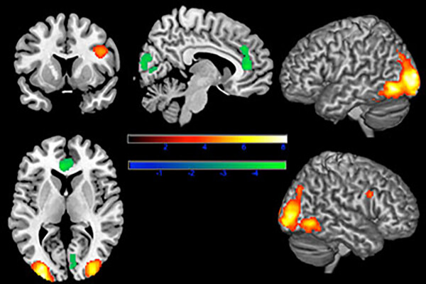 Five scans of brains with colored lights glowing to represent brain activity