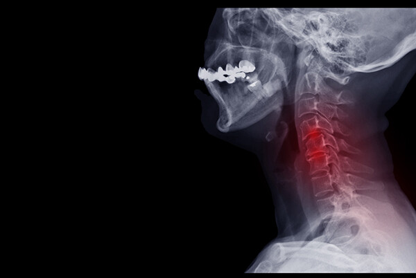 x-ray of spine