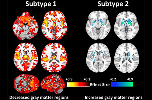 Brain scans of two brains, one with six scans representing Subtype 1 and one with four scans representing Subtype 2, number two has increased gray matter regions while number 1 has decreased gray matter regions.