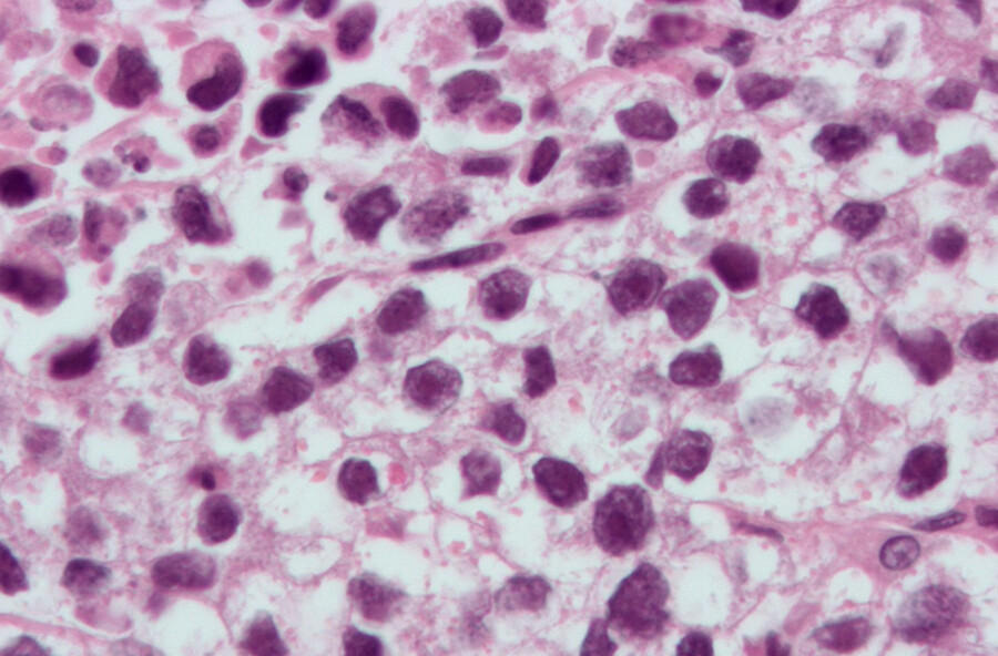 Microscopic image of cancer cells.