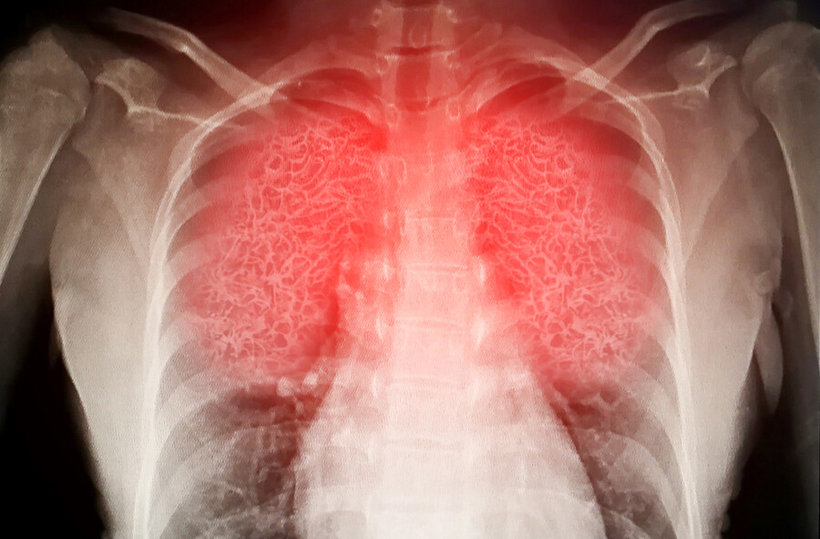 X-ray of lungs illuminated in red.
