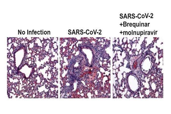 Microscopic view of human respiratory epithelial cells infected with SARS-CoV-2.