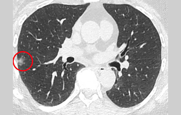 X-ray of a biopsy with a cancerous cell circled in red.