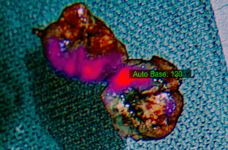 Microscopic view of a tumor glowing.