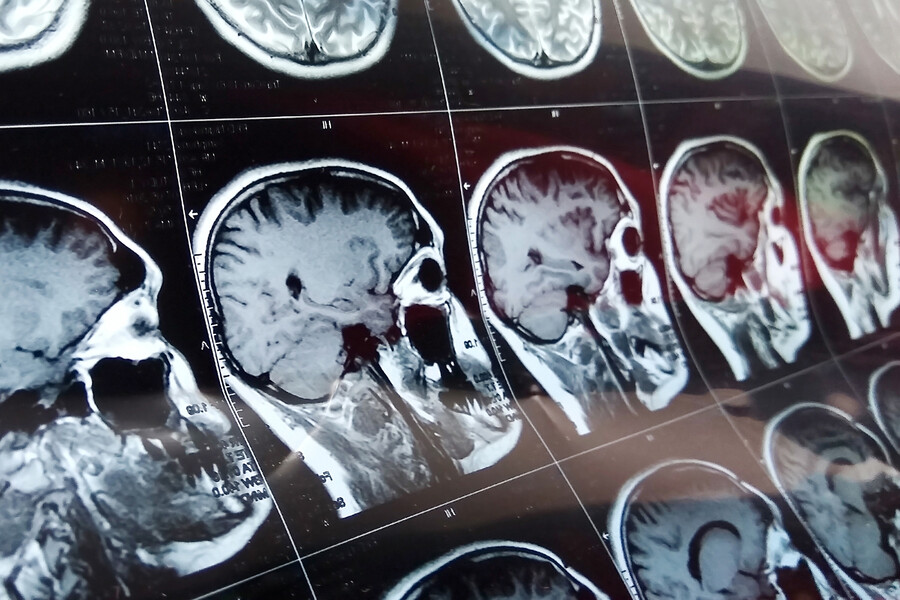 CT scan of a brain.