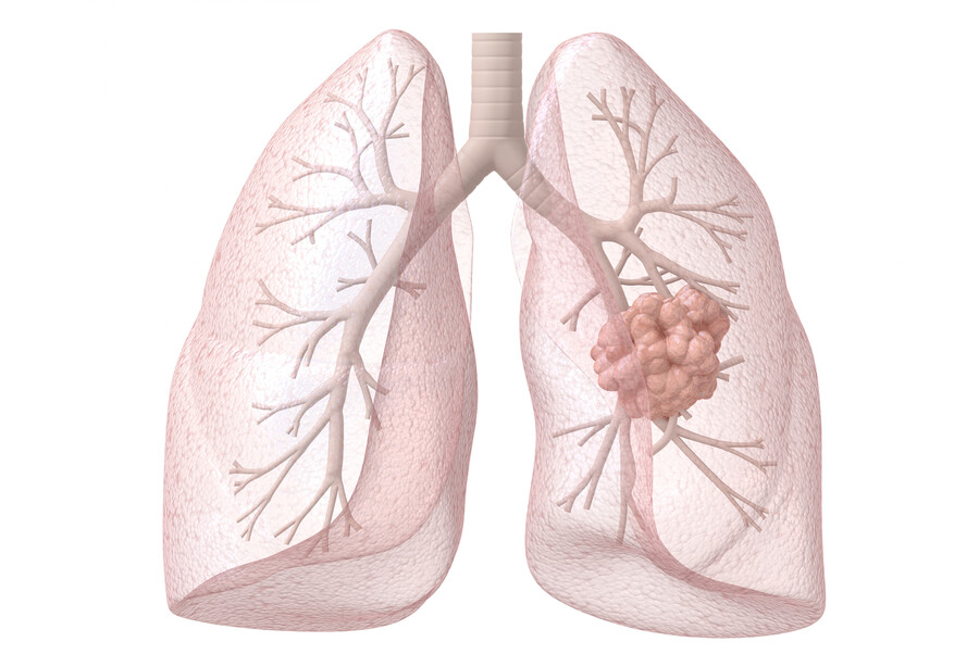 Internal view of lungs with a cancerous growth.