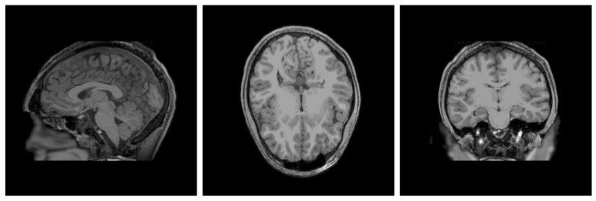 Three views of a brain X-ray