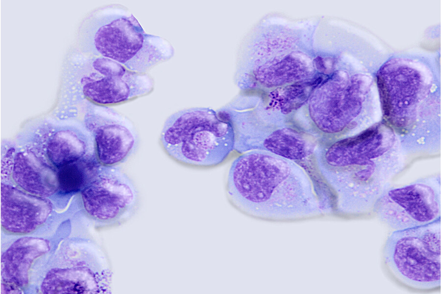 Invariant natural killer T cells.