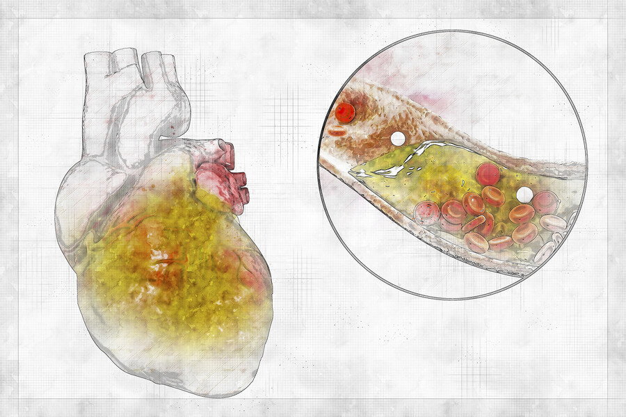 a close-up view of a coronary artery with cholesterol plaque signifying cardiovascular disease and atherosclerosis