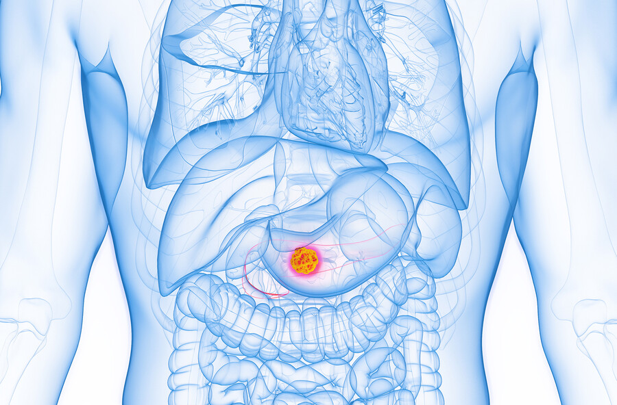 Rendering of a cancer cell in a pancreas