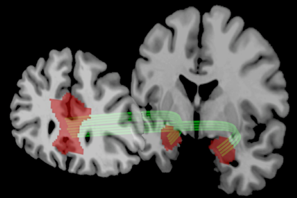 A new study from Penn researchers Joseph Kable and Caryn Lerman linked the amygdala and the prefrontal cortex to risk tolerance.