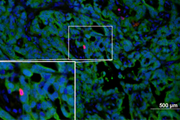 t_cell_low_tumor
