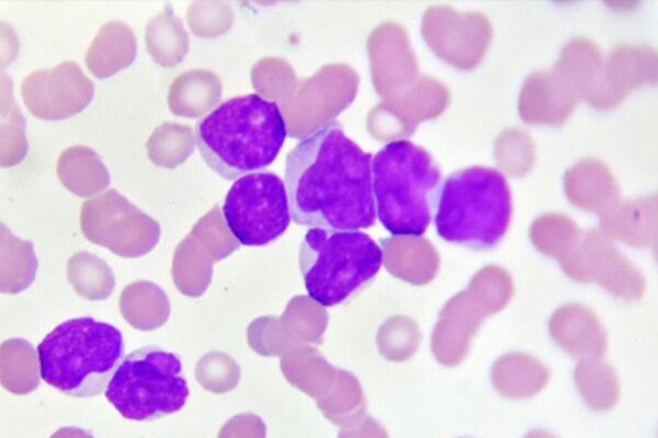 microscopic image of acute myeloid leukemia cells