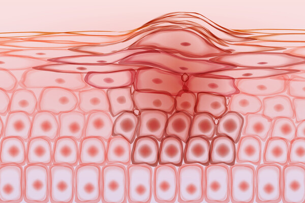 raised surface of melanoma amidst microscopic skin cells