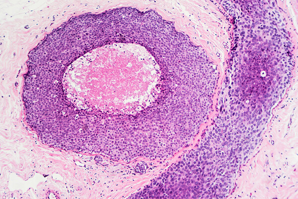 Microscopic image of breast cancer cells.