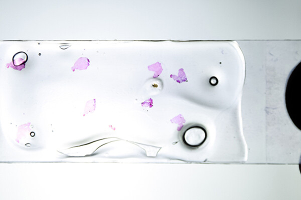 Microscopic slices of tumor on a glass slide