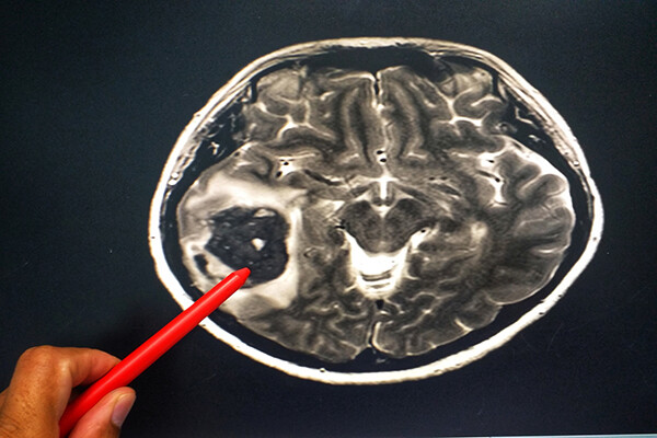 x-ray of a brain tumor