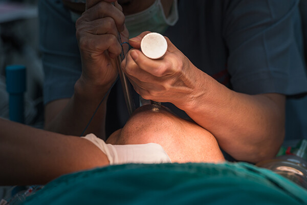 closeup of doctor’s hands intubating a patient