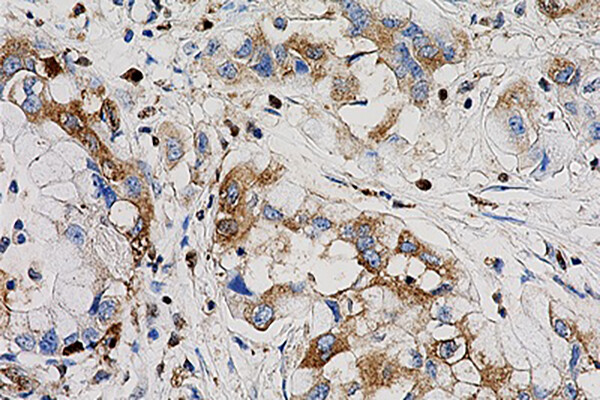 Microscopic view of pancreatic cancer cells