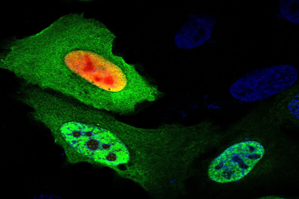 Microscopic image of cancer proteins.