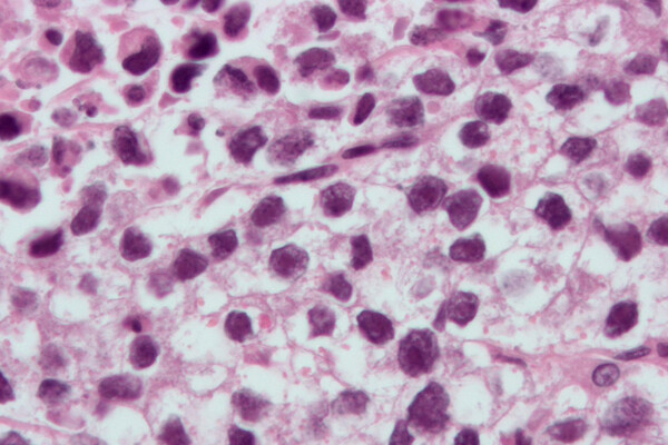 Microscopic image of cancer cells.