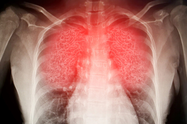 X-ray of lungs illuminated in red.
