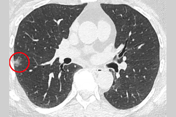 X-ray of a biopsy with a cancerous cell circled in red.