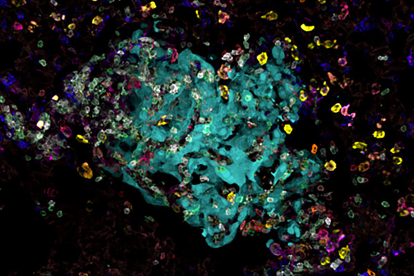Microscopic view of cancer cells.