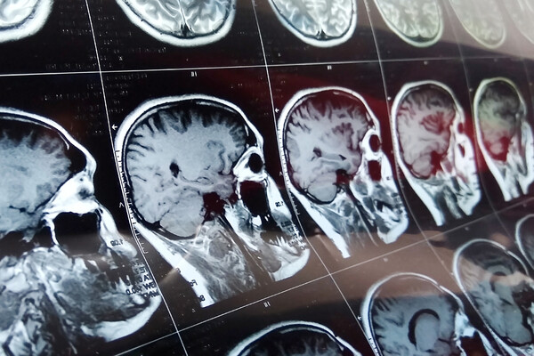 CT scan of a brain.