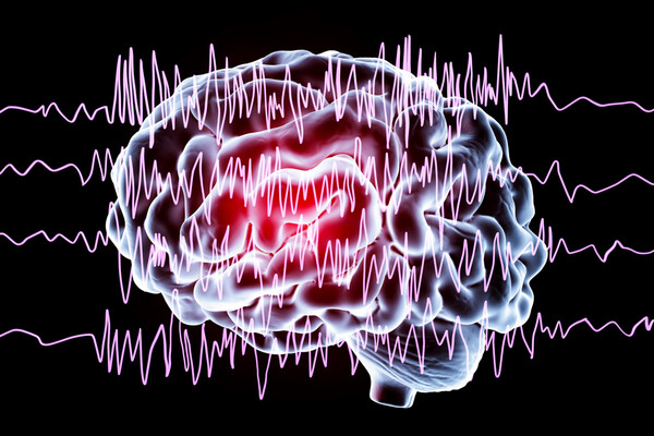 concept of brain cells in a seizure event.