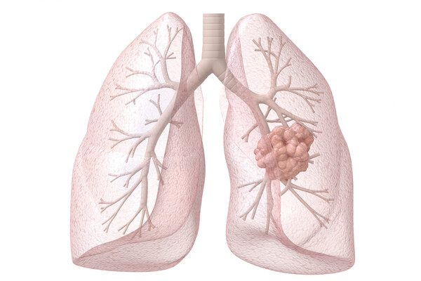 Internal view of lungs with a cancerous growth.