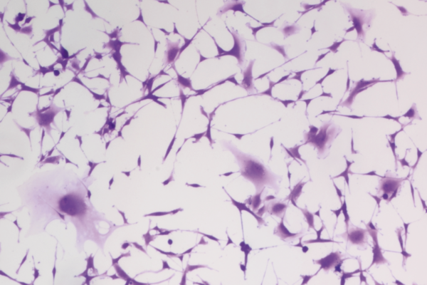 Fluorescent imaging of glioblastoma under a microscope.