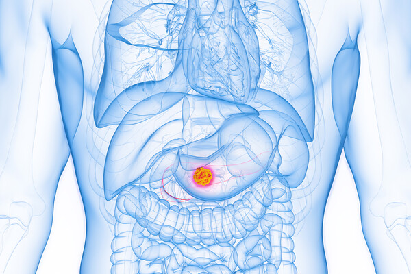 Rendering of a cancer cell in a pancreas