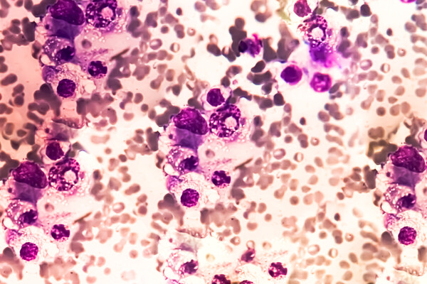 microscopic view of Multiple myeloma.